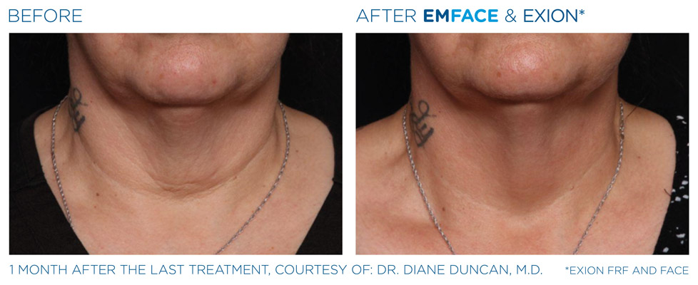 Chin
