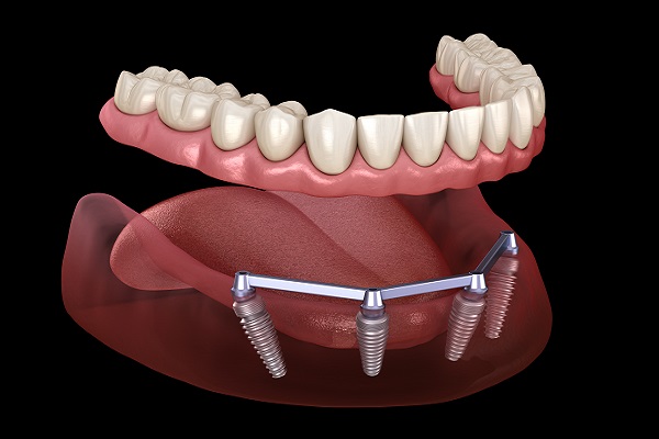 What Is All On  ® And How Can It Replace Missing Teeth?