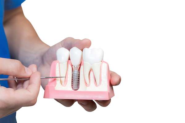 Can You Get Dental Implants if You Have Gum Disease from Mission Valley Dental Arts in San Diego, CA