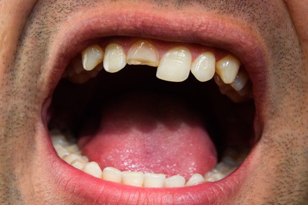 When To See A Dentist About A Chipped Tooth