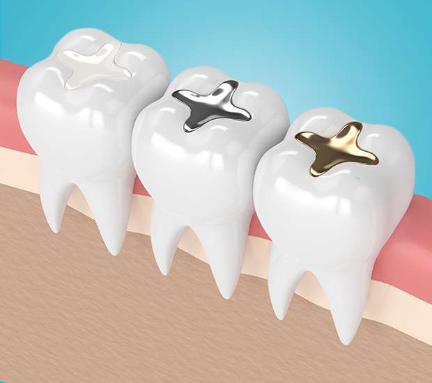 San Diego Composite Fillings