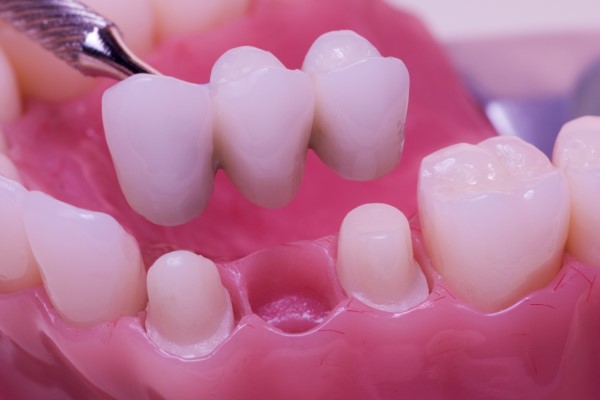 Can A Dental Bridge Help With Teeth Alignment?