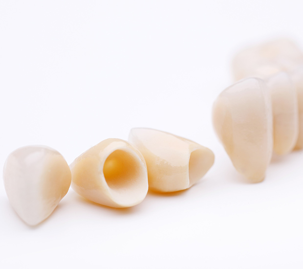 San Diego Dental Crowns and Dental Bridges