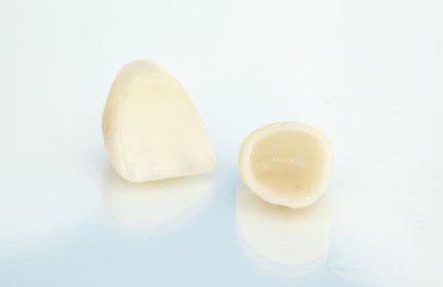 Implant Crowns