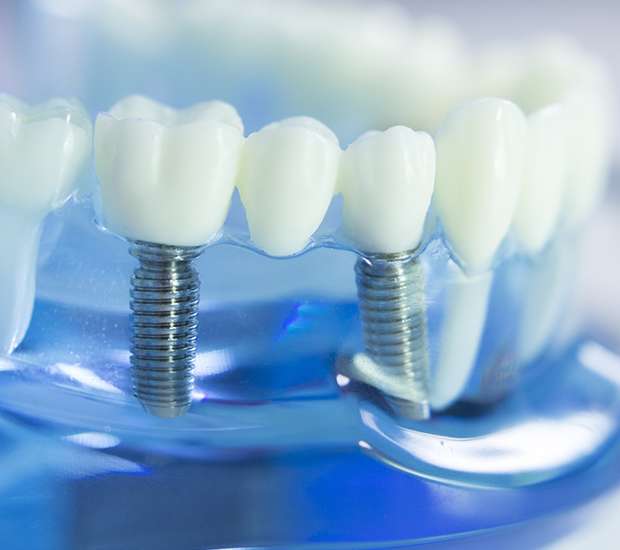 San Diego Dental Implants