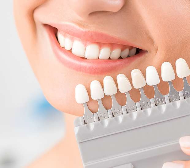 San Diego Dental Veneers and Dental Laminates