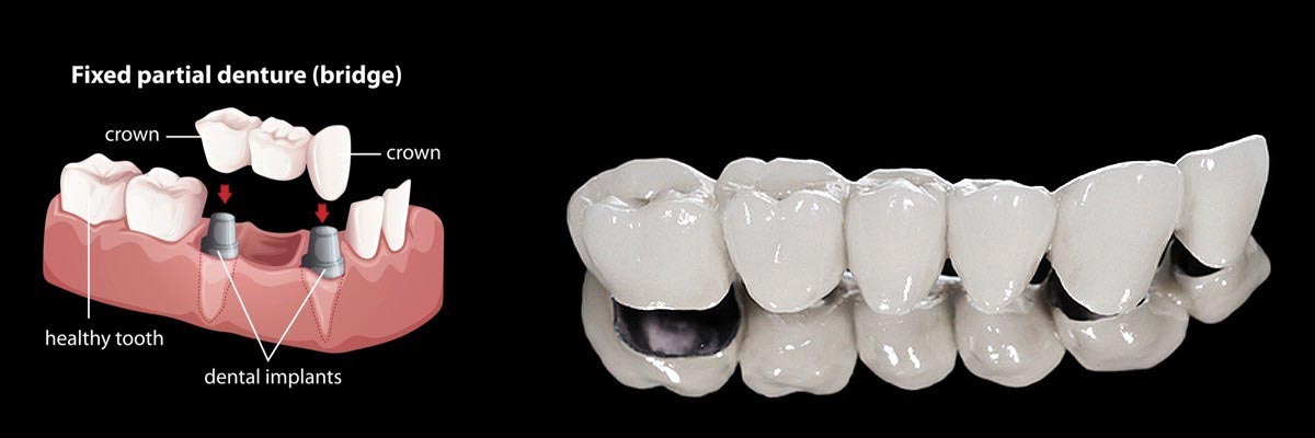San Diego Dentures