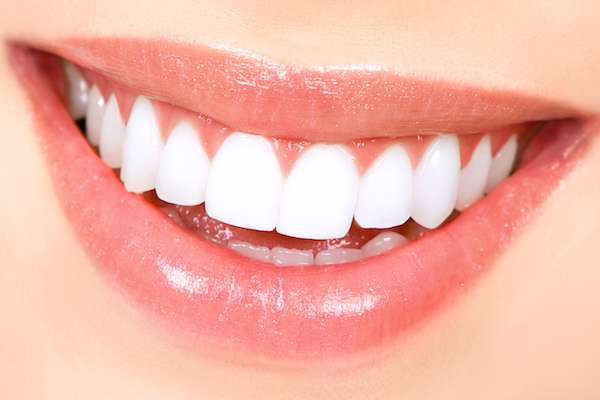 How Long Does Teeth Whitening Take from Mission Valley Dental Arts in San Diego, CA