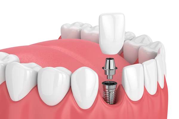 How Painful is Dental Implant Surgery from Mission Valley Dental Arts in San Diego, CA