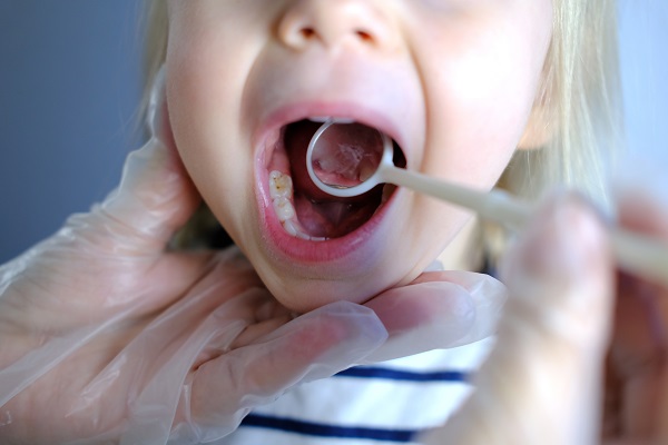Types Of Dental Fillings For Kids Offered By A Kid Friendly Dentist In San Diego