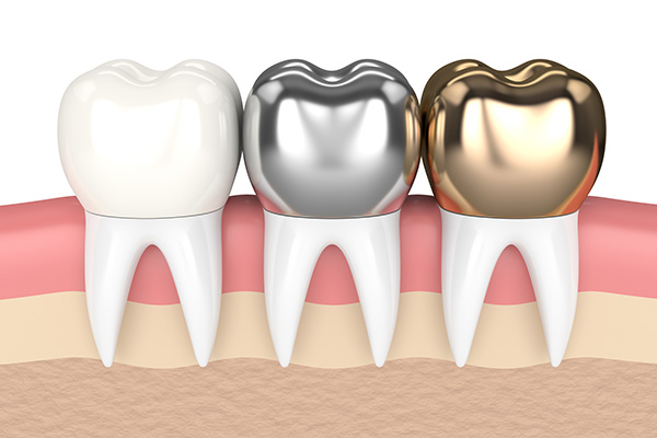 Metal Crowns vs. Porcelain Dental Crowns from Mission Valley Dental Arts in San Diego, CA