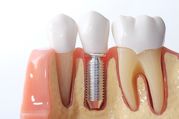Options for Replacing a Single Missing Tooth from Mission Valley Dental Arts in San Diego, CA