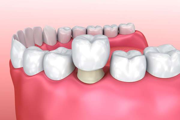 Permanent Dental Crowns vs. Temporary: Is There a Difference from Mission Valley Dental Arts in San Diego, CA