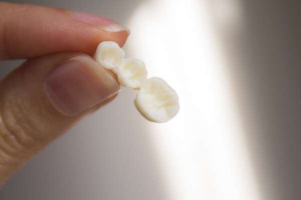Replace Missing Teeth with Dental Bridges from Mission Valley Dental Arts in San Diego, CA