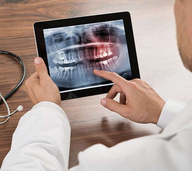 San Diego Types of Dental Root Fractures