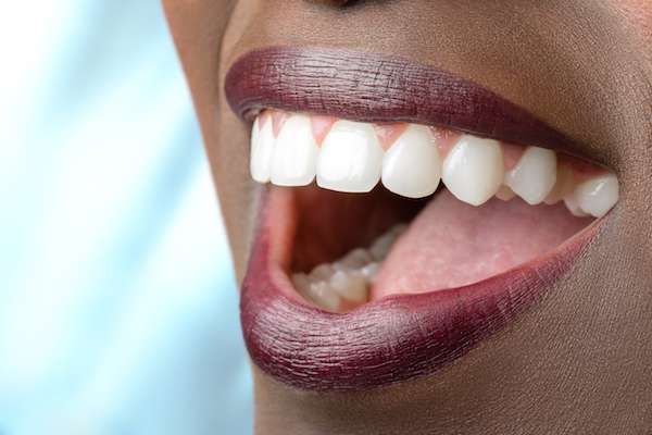 Routine Dental Care: What Are Tooth Colored Fillings from Mission Valley Dental Arts in San Diego, CA