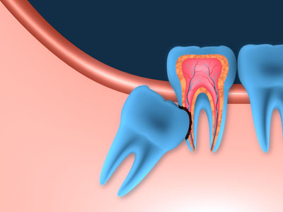 wisdom teeth before and after