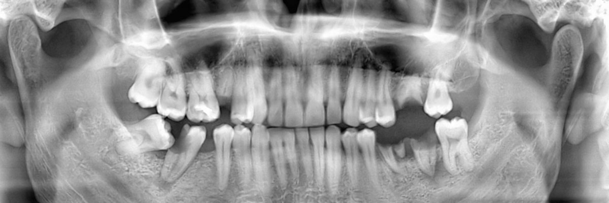 San Diego Wisdom Teeth Extraction
